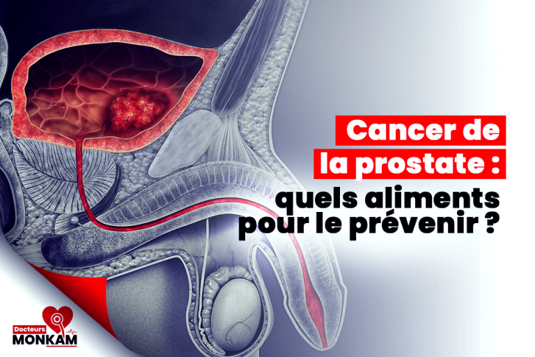 Cancer de la prostate : quels aliments pour le prévenir ?