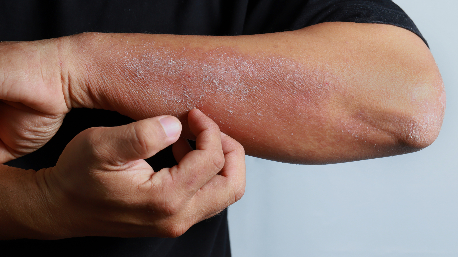 Problèmes de peau et travail : les causes des dermatoses professionnelles