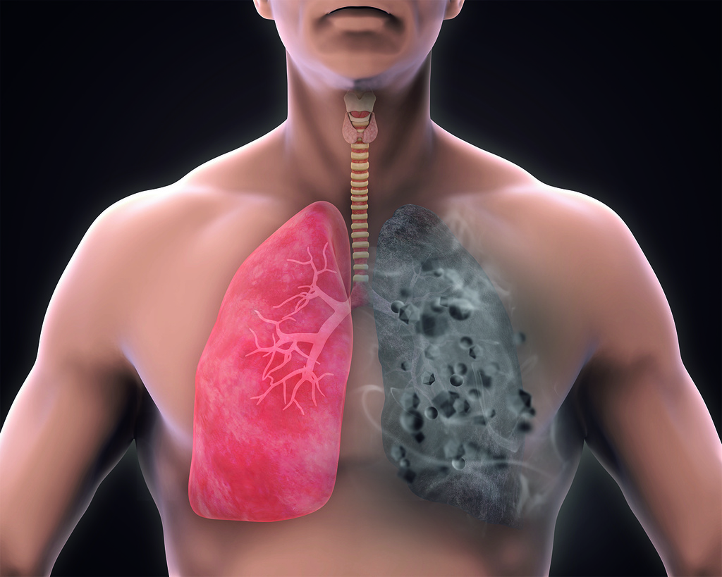 Toux et fumeurs : Comment réduire les risques et améliorer la santé pulmonaire ?