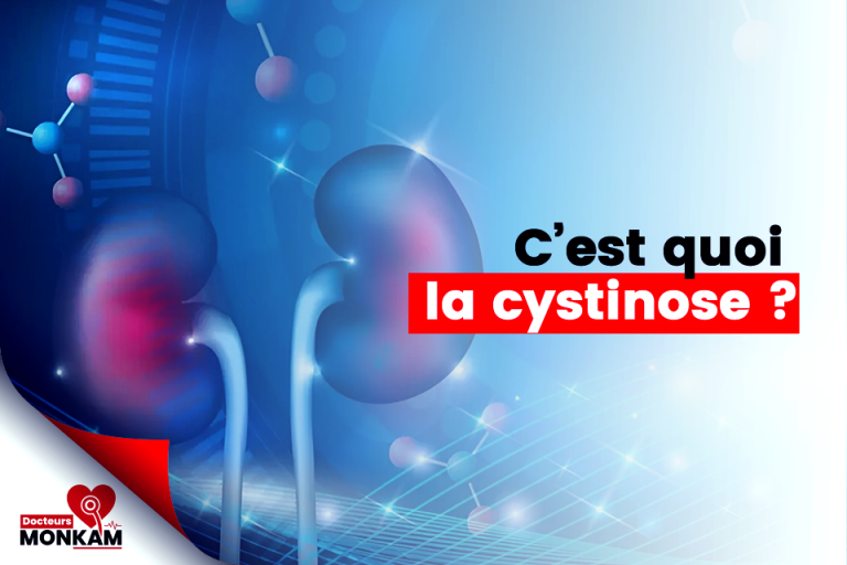 La cystinose : causes, diagnostic, traitement