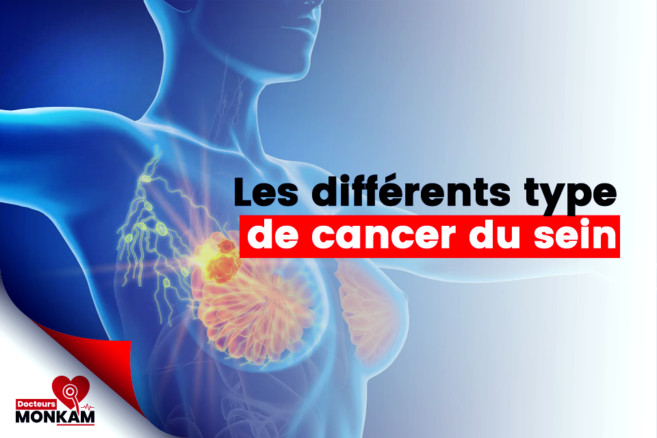 Quels sont les types de cancer du sein ?